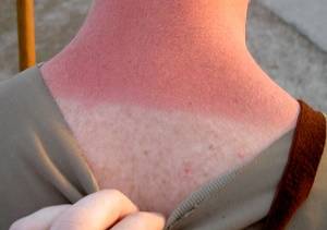 Sunburn Treatment and Prevention: How to Treat Sun Blisters